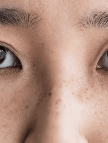 pigmentation care in your 20s
